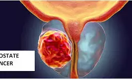 Prostrate cancer, major plague for men- BATRO