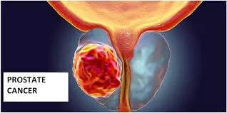 Prostrate cancer, major plague for men- BATRO