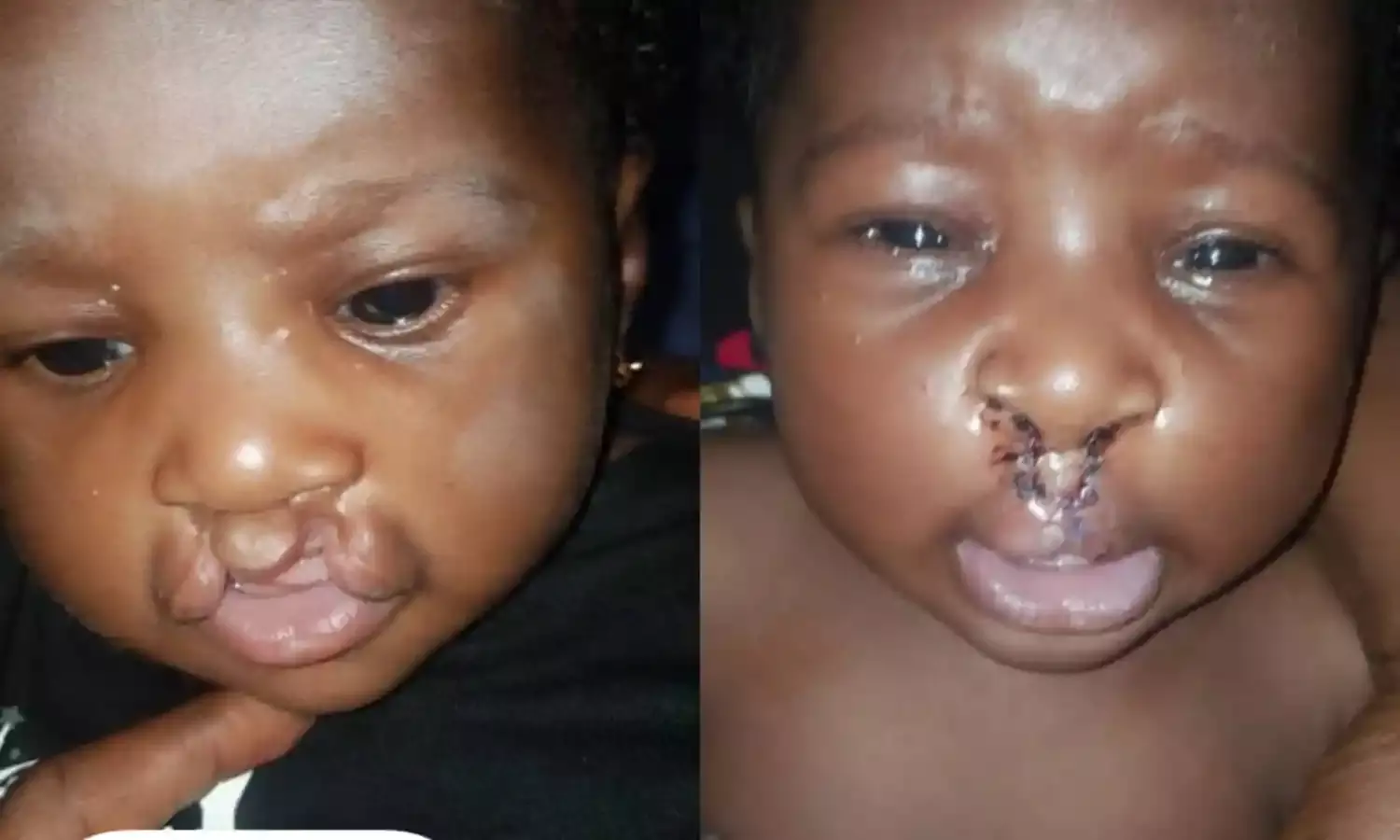 Cleft lips: Speech therapist advises parents