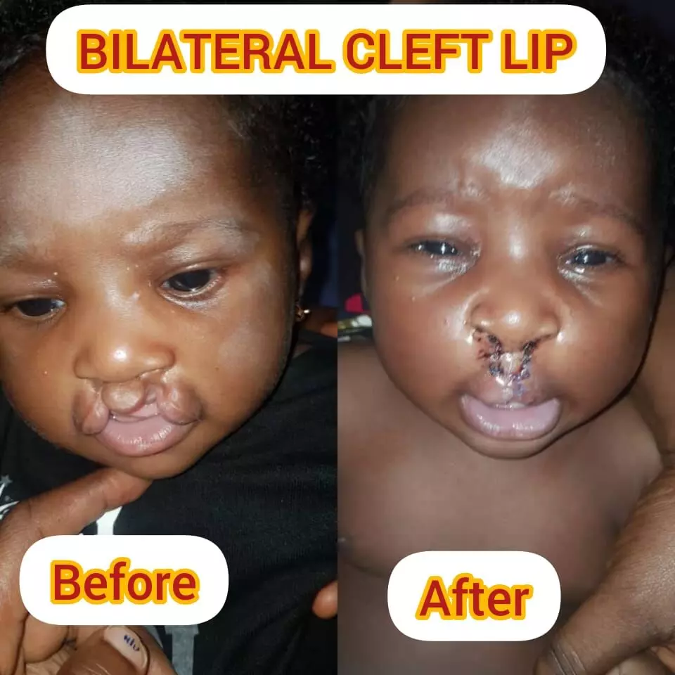 Cleft lips: Speech therapist advises parents Cleft lips: Speech therapist advises parents