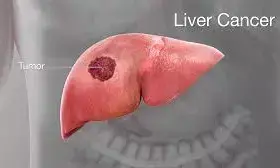 Liver cancer, silent epidemic among Nigerian