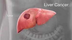 Liver cancer, silent epidemic among Nigerian Liver cancer, silent epidemic among Nigerian