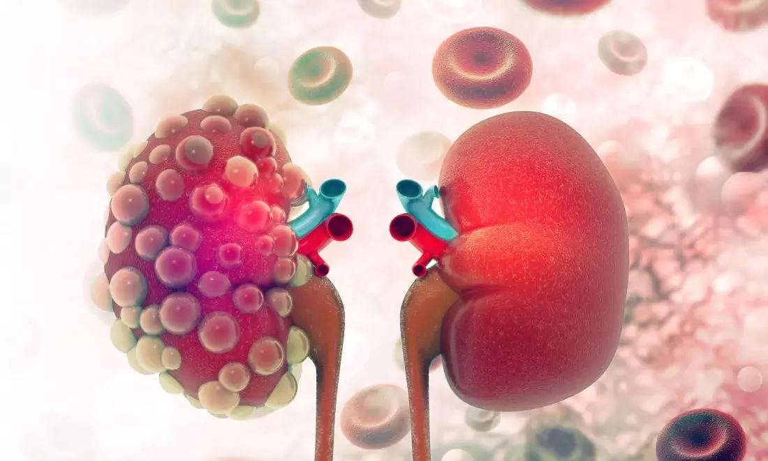 Why late diagnosis leads to high cost of kidney treatment – Nephrologist