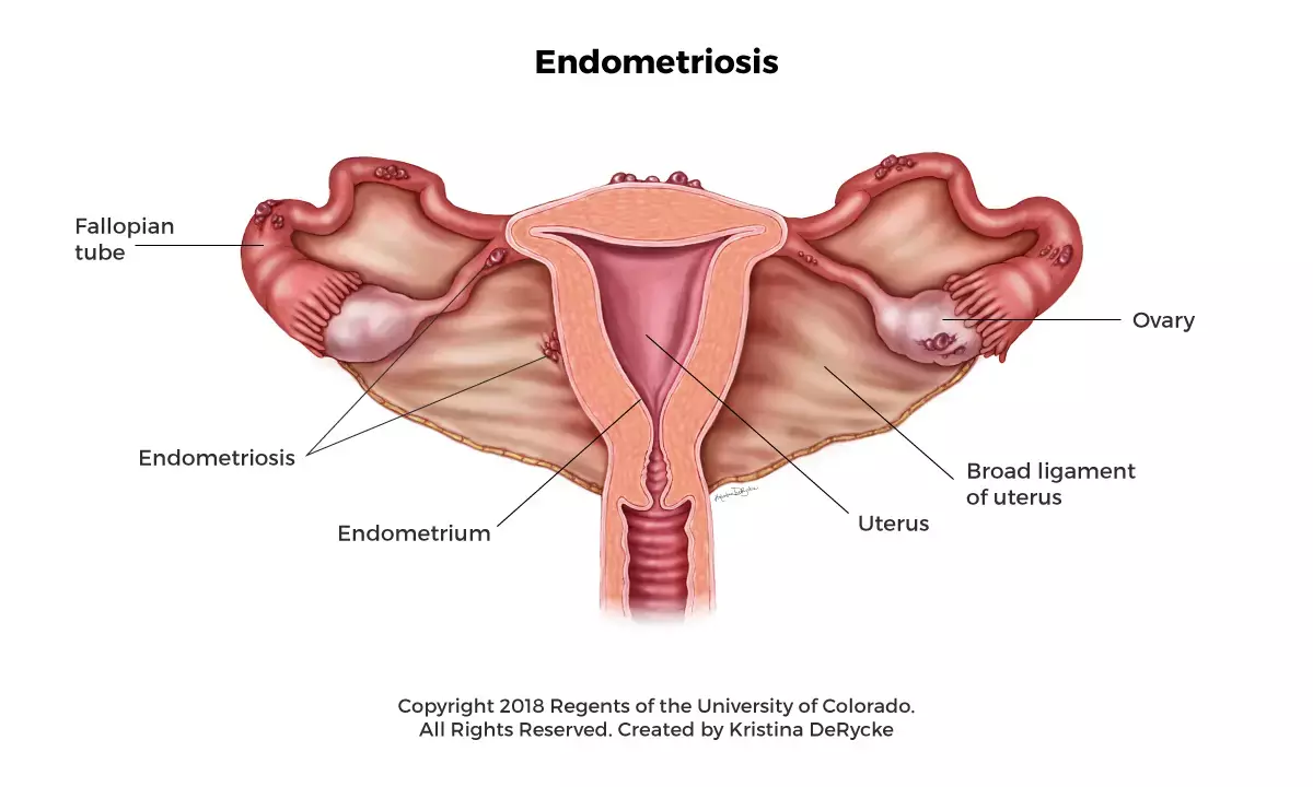 Revealing endometriosis disorder, major cause of infertility in female