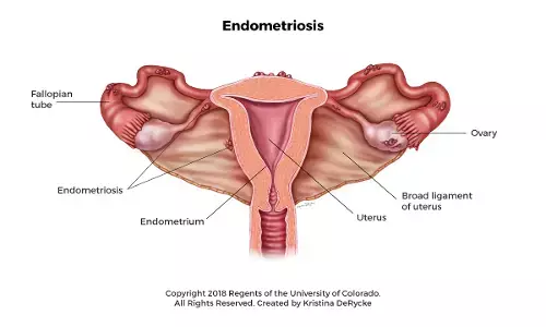 Revealing endometriosis disorder, major cause of infertility in female