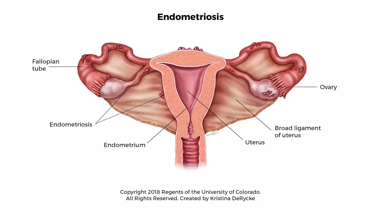 Revealing endometriosis disorder, major cause of infertility in female Revealing endometriosis disorder, major cause of infertility in female