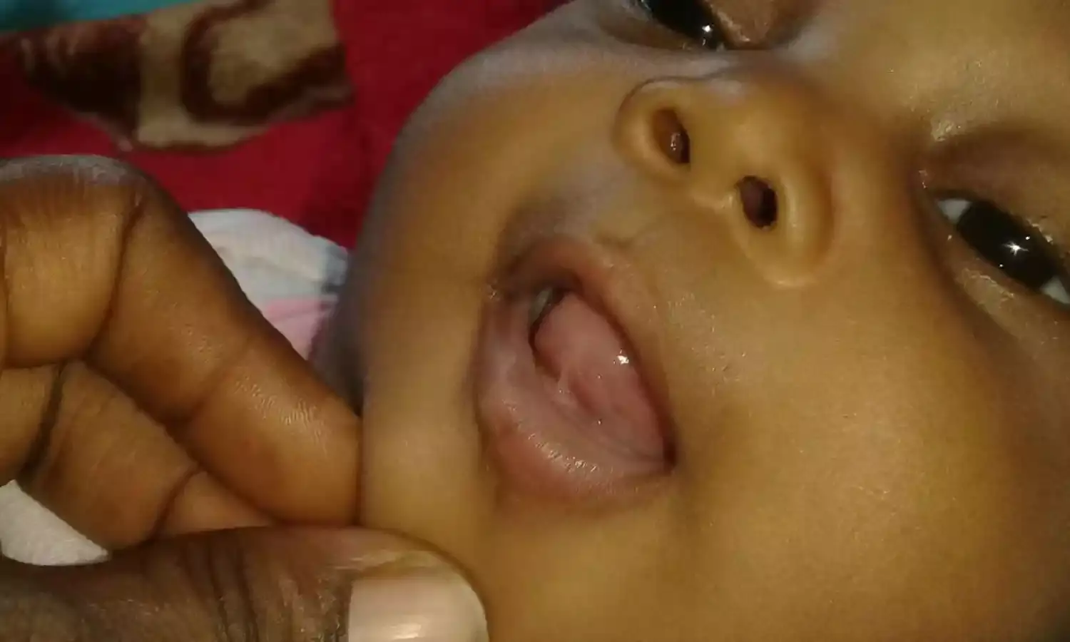 How to discover tongue-tie in sucking babies  – Therapist