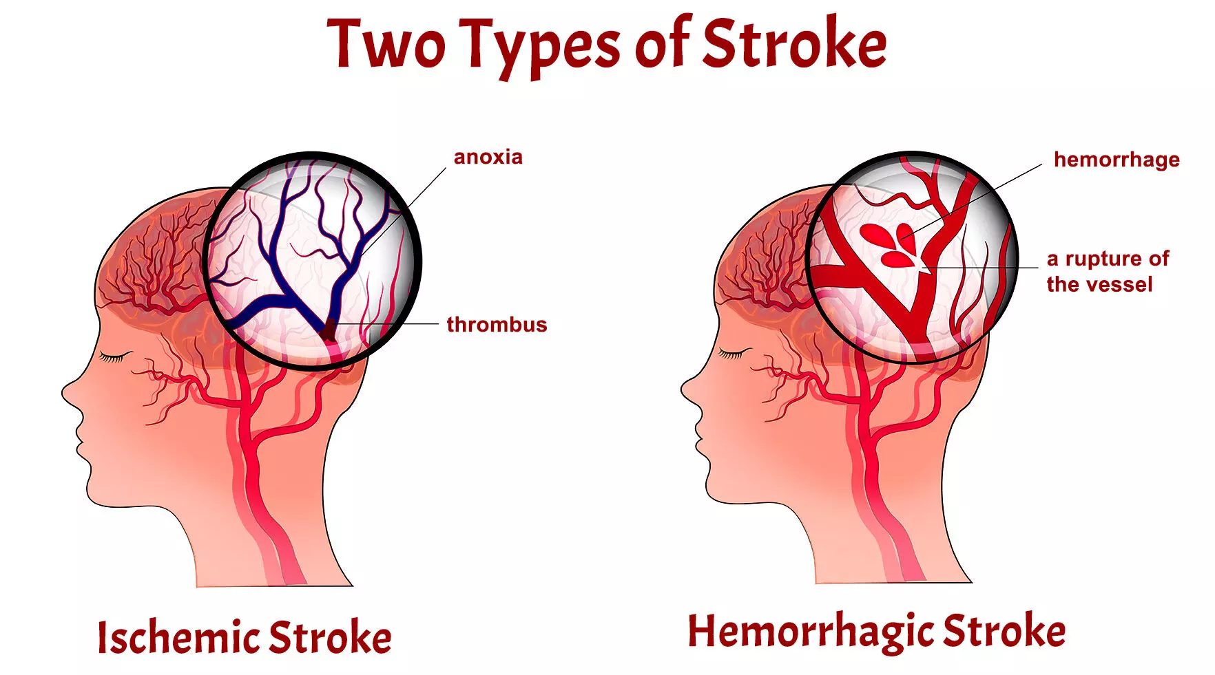 How treatment of heart rhythm disorderprevent recurrent stroke — Study How treatment of heart rhythm disorderprevent recurrent stroke — Study