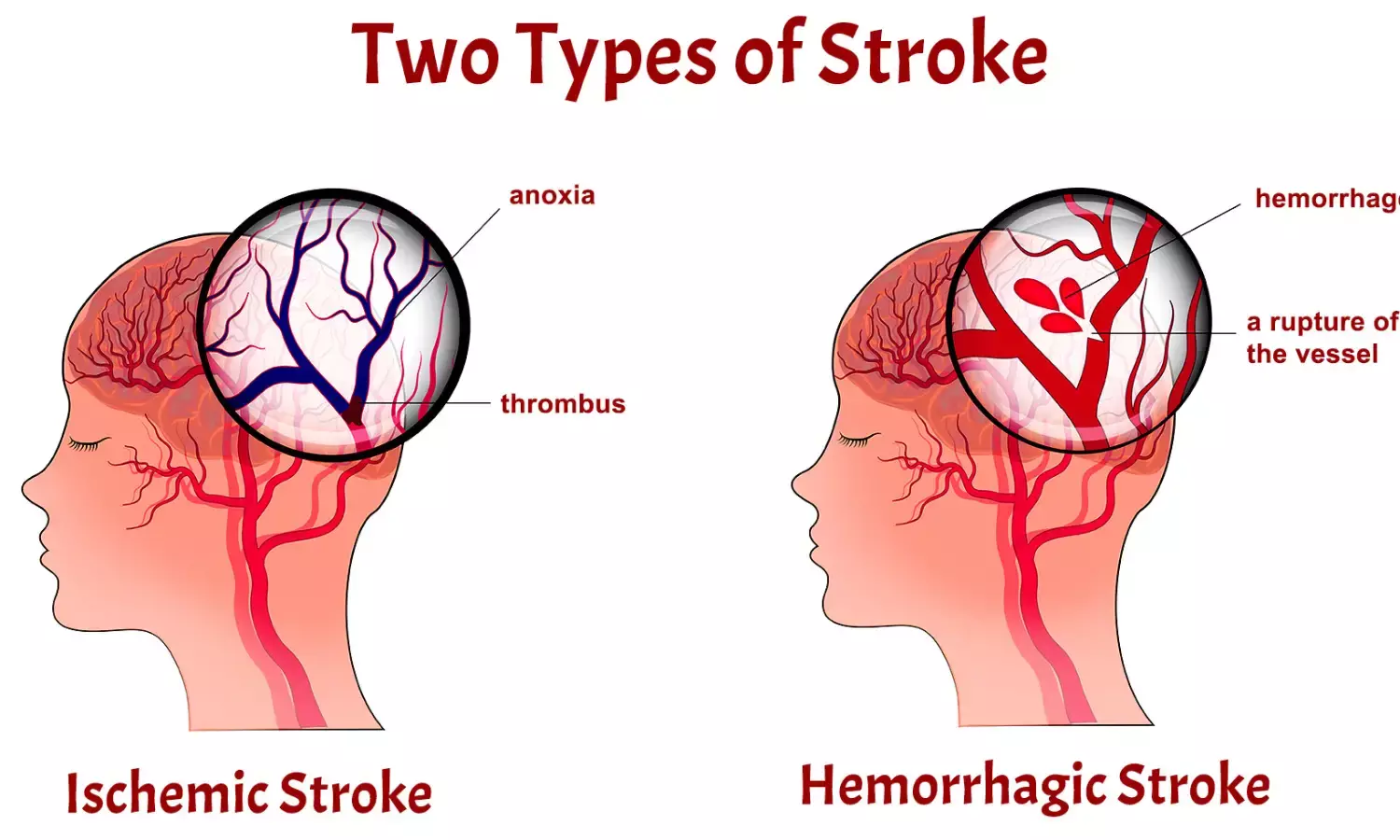 How treatment of heart rhythm disorderprevent recurrent stroke — Study
