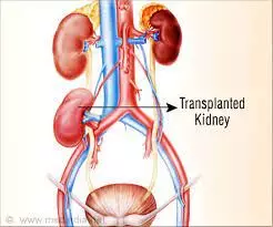 Cameroon breakthrough in 3 kidney transplant operations