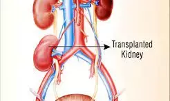 Cameroon breakthrough in 3 kidney transplant operations