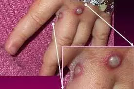 France sees 1st case of monkeypox