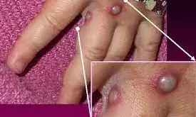 France sees 1st case of monkeypox