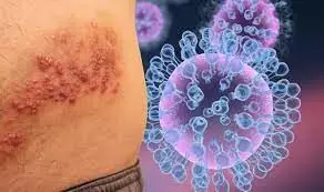 Portugal sees 14 new monkeypox cases, total at 37 Portugal sees 14 new monkeypox cases, total at 37