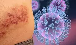 Portugal sees 14 new monkeypox cases, total at 37