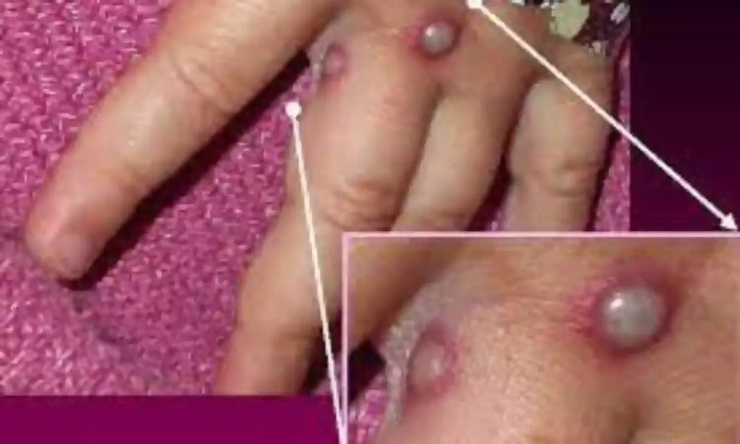 1st case of monkeypox reports in Czech Republic