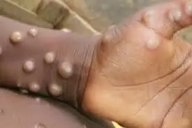 Monkeypox: Nigeria sees six cases, one death in May