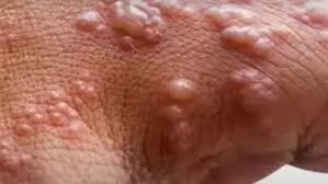 WHO records over 550 monkey pox cases WHO records over 550 monkey pox cases