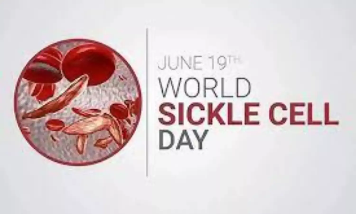 World Sickle Cell Day: Yobe offers free clinical care to sickle cell carriers