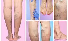 Driving awareness on deep vein thrombosis and anticoagulant therapy