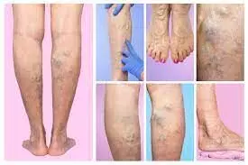 Driving awareness on deep vein thrombosis and anticoagulant therapy