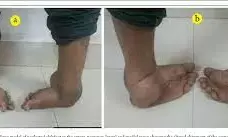 Why children are born with clubfoot – Ibrahim-Maifada