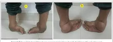 Why children are born with clubfoot – Ibrahim-Maifada