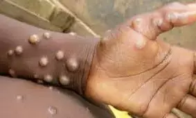 Edo sees eight cases of monkeypox