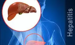 FG regrets over low Hepatitis awareness, treatment