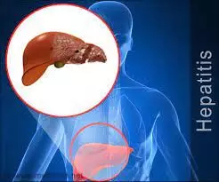 FG regrets over low Hepatitis awareness, treatment FG regrets over low Hepatitis awareness, treatment