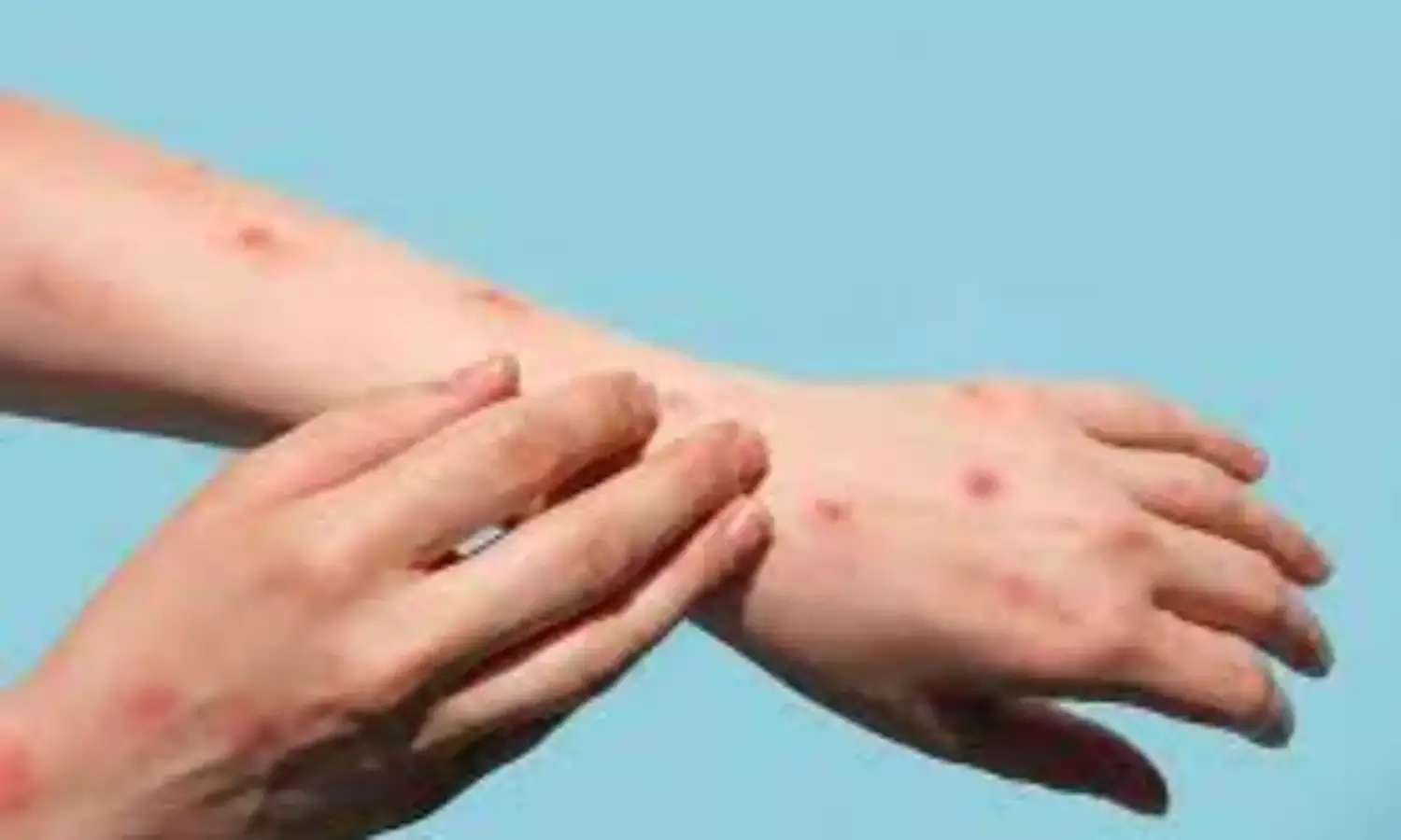 Philippines confirms 1st monkeypox case