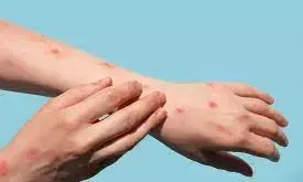 Monkeypox: Experts give virus variants new names