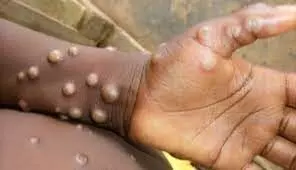 Monkey pox: Tests to determine suspected case in Osun, says Official Monkey pox: Tests to determine suspected case in Osun, says Official