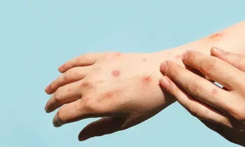 Infant in Luxembourg infected with monkey pox, says health ministry