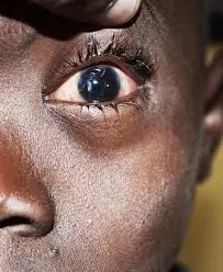 FG wants to introduce eye care treatment into PHC services