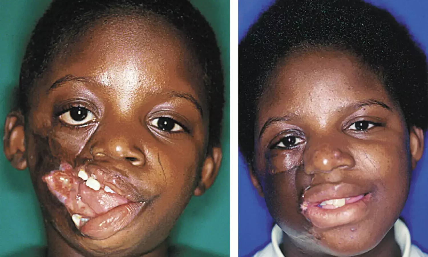 Center offers free care to Noma patients