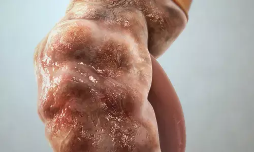 Expert laments high kidney disease burden in Nigeria