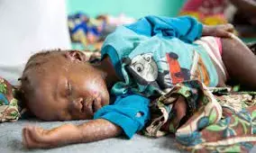 Measles: UN agencies aid S. Africa’s mass vaccinations against outbreak Measles: UN agencies aid S. Africa’s mass vaccinations against outbreak