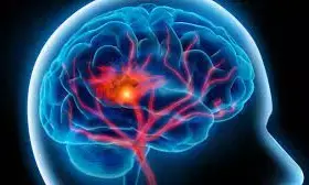 6 indigenous Africans get stroke every minute, every hour – Expert