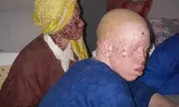 Association laments spate of skin cancer among albinos