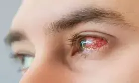 Schools closed in India amid rising cases of eye flu