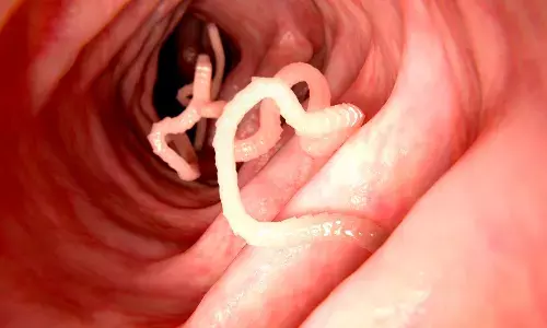 World-first discovery: Live worm found in woman’s brain