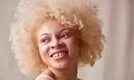 What you need to know about Albinism