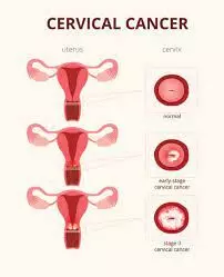 Nigeria can reduce cervical cancer prevalence by 98% — Oncologist