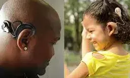 Include cochlear implants in NHIA package for deaf patients – Stakeholders urge FG Include cochlear implants in NHIA package for deaf patients – Stakeholders urge FG