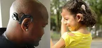 Include cochlear implants in NHIA package for deaf patients  – Stakeholders urge FG