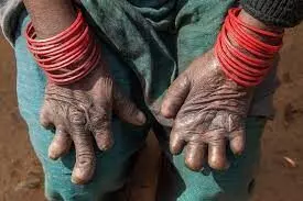 People living with leprosy seek urgent action to end social exclusion
