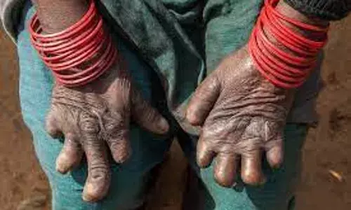 People living with leprosy seek urgent action to end social exclusion