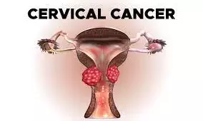 AU needs collaborative initiative to tackle cervical cancer challenges – Expert