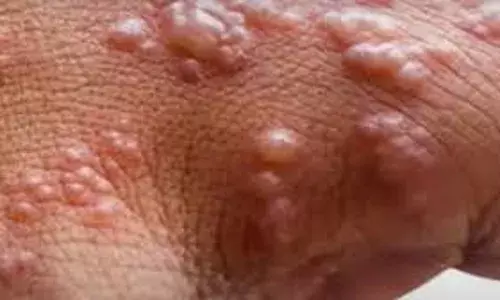 WHO says Mpox remains global health threat